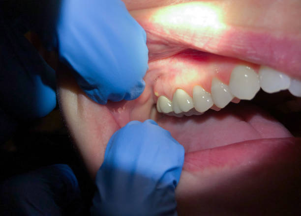 Best Urgent Care for Lost Fillings or Crowns in Leland, NC